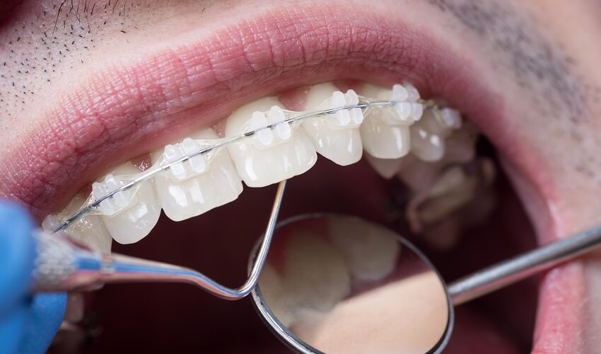 יישור שיניים בשיטה השקופה_2