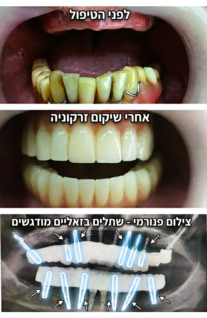 תמונה של פה של מטופל עם שיניים במצב לא טוב, מאוחדת עם תמונה נוספת לאחר השתלת שיניים במרפאת השיניים דנטל אסתטיקס קליניקס - ד"ר ותד מחמוד. וצילום סיטי המראה היכן הוחדרו השתלים הבזאלים.